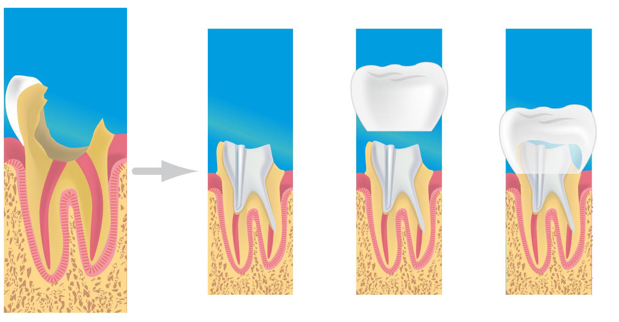 prothèse dentaire creteil 