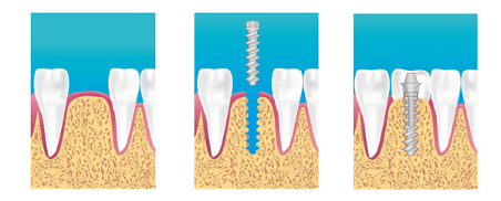 implant dentaire créteil